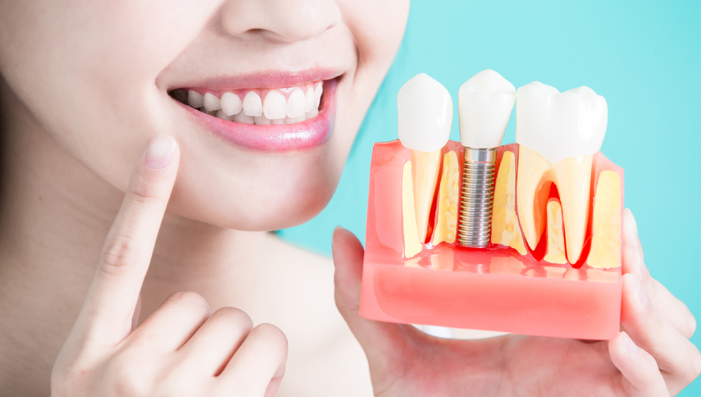 dental implant-kochi