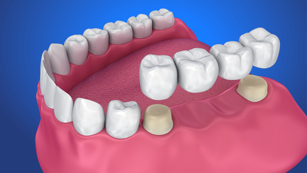 dental implant treatment kochi