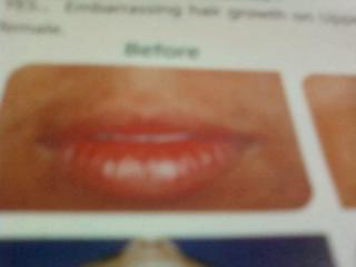 Lips Treatment
