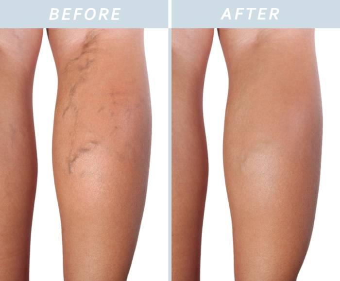 Alternative Treatment for Varicose Veins